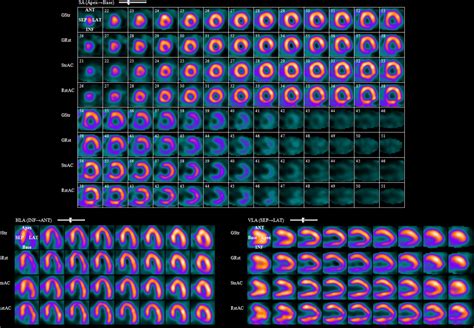 Single Photon Emission Computed Tomography Spect Myocardial Perfusion