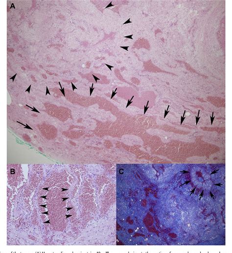 Figure From Multiple Mixed Cavernous And Venous Hemangioma Of The