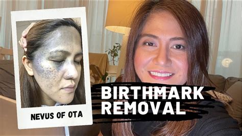 9th Session Nevus Of Ota Birthmark Removal Using Laser Qswitch Nd