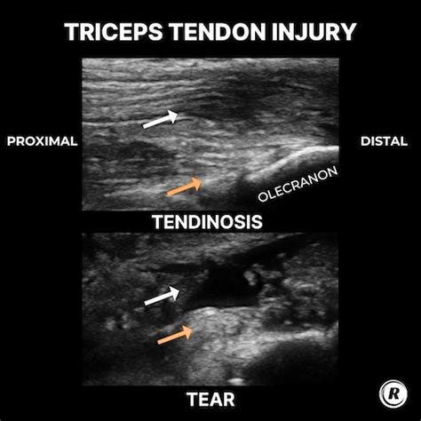 What Does A Triceps Tendon Tear Look Like On Ultrasound Rita Chorba PT