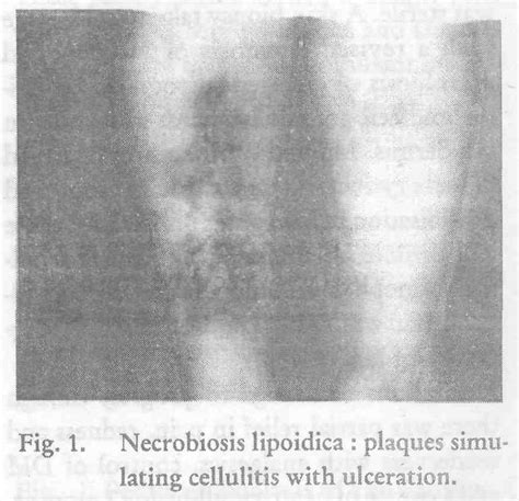 Necrobiosis lipoidica mimicking cellulitis - Indian Journal of ...