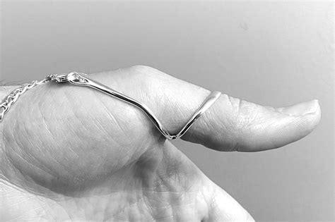 Thumb MCP Problems | Hyperextension of the MCP Joint | Silver Ring Splint