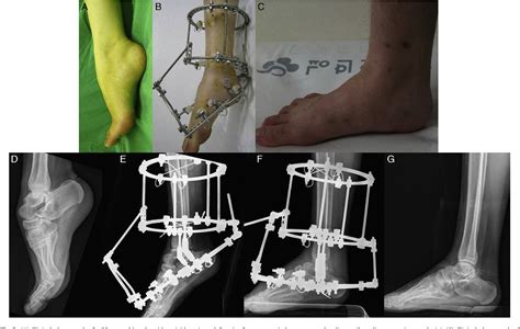 Figure From Use Of Ilizarov External Fixation Without Soft Tissue