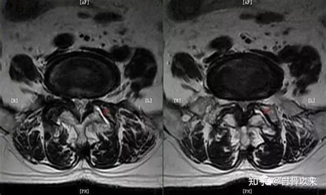 腰椎间盘突出ct片子怎么看？教你看腰椎间盘突出ct影像学表现 知乎