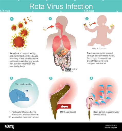 Rotavirus Infection High Resolution Stock Photography And Images Alamy