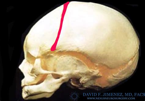 Metopic Suture