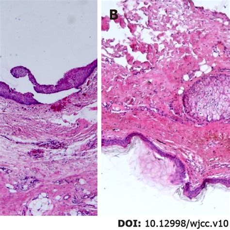 Histopathological Analysis Of The Teratoma A And B The Cyst Wall Was