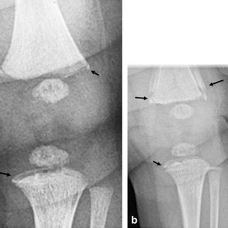 Abusive Head Trauma In A Month Old Boy A Sagittal Mri Of The Spine