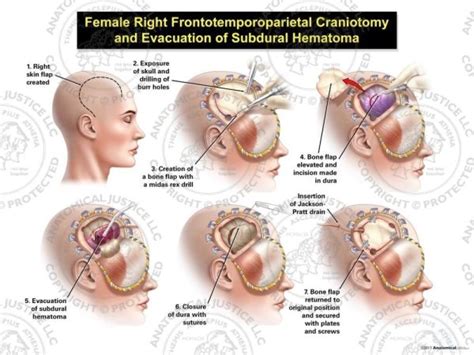 Female Right Frontotemporoparietal Craniotomy And Evacuation Of