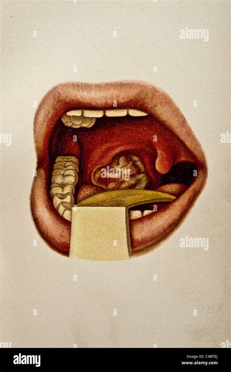 Anterior Tonsillar Pillar