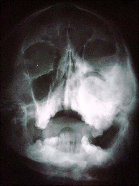 Fibrous Dysplasia Of Maxilla