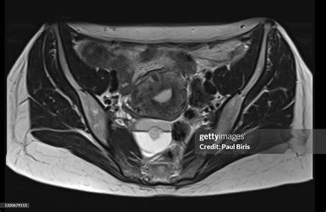 Ovarian Dermoid Cyst And Mature Cystic Ovarian Teratom Seen On Mri Examination Of The Female