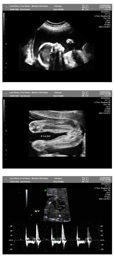 3 Fetuses 25 Weeks Ultrasound Girl Ultrasounds