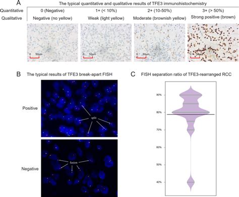 Tfe Gene Rearrangement And Protein Expression Contribute To A Poor