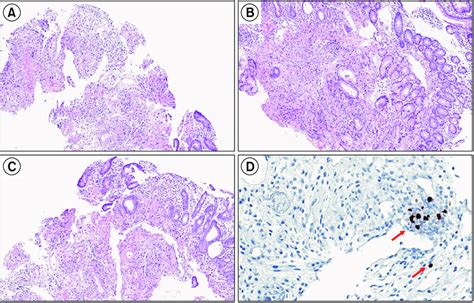 Histologic findings of the patient. (A-C) Duodenal biopsy (H&E, ×20).... | Download Scientific ...