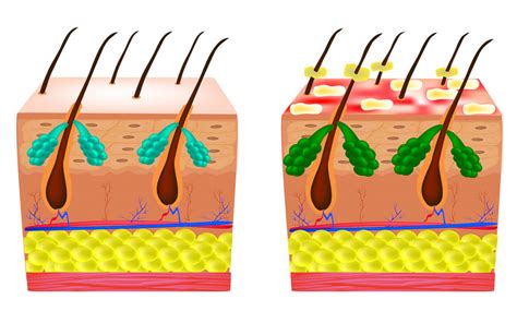 Hair Fungus: What Is It, And How Can It Be Treated? | Elithair