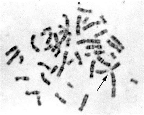 Proband 1 Karyotype With Acrocentric Chromosomes Forming Associations Download Scientific