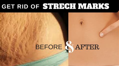 Get Rid Of Stretch Marks Fast Natural Home Remedies For Stretch Marks