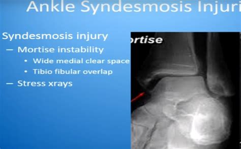 Ankle Syndesmotic Injuries — OrthopaedicPrinciples.com