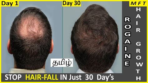 Rogaine Minoxidil For Hair Regrowth In 30 Days Where To Buy Rogaine