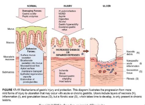 Gastritis And Peptic Ulcer Disease Flashcards Quizlet