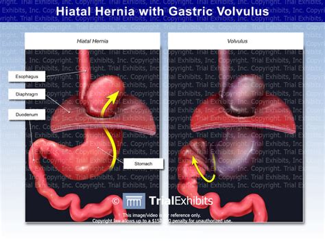 Hiatal Hernia With Gastric Volvulus Trialquest Inc