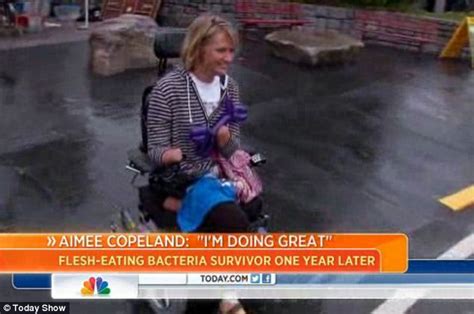 Aimee Copeland Flesh Eating Bacteria Victim Braves The Cameras As She