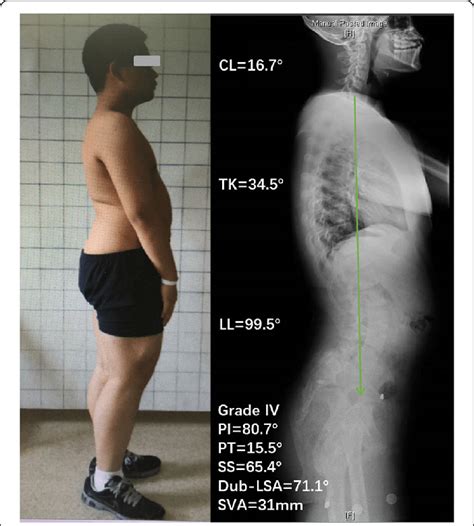 Lordosis Treatment Before After