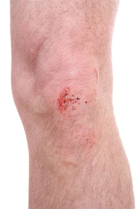 Scraped Knee stock image. Image of first, background - 15750907