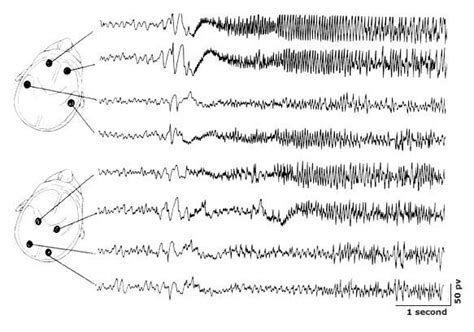 10 best images about Tonic-clonic (grand mal) Seizure on Pinterest | Medicine, Type chart and ...