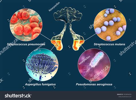 Anatomy Rhinosinusitis Microorganisms That Cause Sinusitis Stock