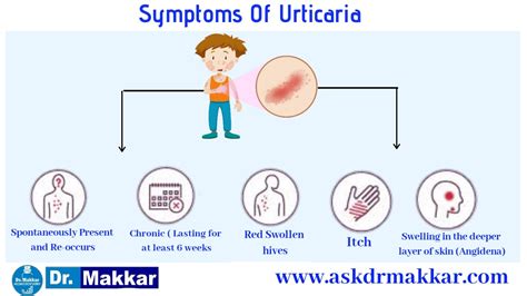 Urticaria Hives Homeopathic Treatment Skin Allergic Reaction Creating