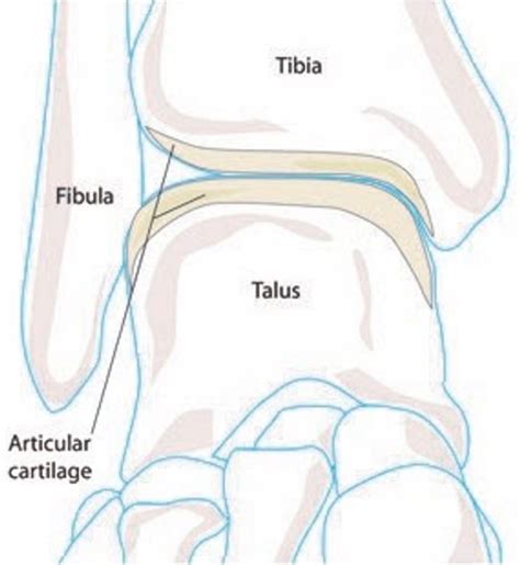 Condition Spotlight Talar Dome Injuries Watsonia Podiatry