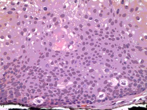 Inverted Follicular Keratosis - Dermatology Advisor