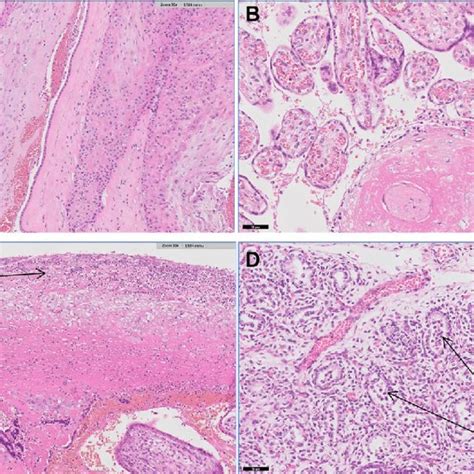 Histopathology images of normal amnion and abnormal amnion from the ...