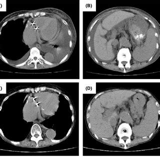 Histological Findings Of TAFRO Syndrome Lymph Nodes A B And Bone