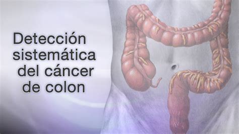 Spanish HIE Multimedia Detección sistemática del cáncer de colon