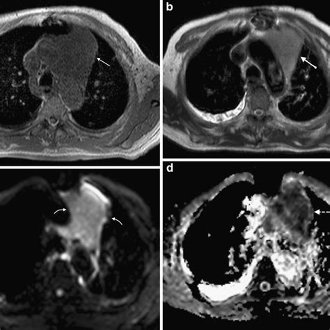 Sarcoidosis A 43 Year Old Woman With Para Aortic And Right Para Download Scientific Diagram