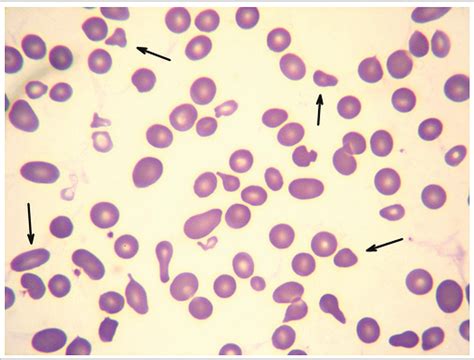 SciELO Brasil Thrombotic Thrombocytopenic Purpura A Case Report