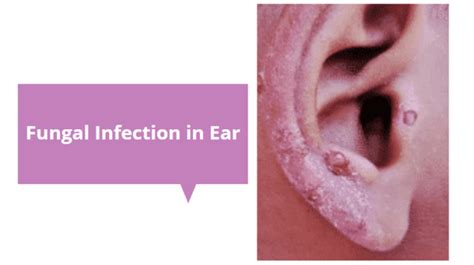 Fungal Infection in Ear Canal - Causes - 7 Best Home Remedy