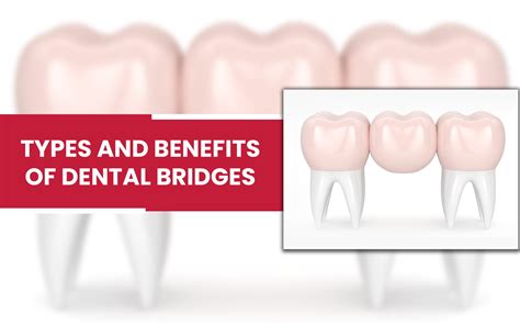 An overview of Dental Bridges - Types and Benefits