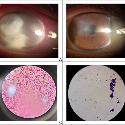 A Case Of Mixed Bacterial And Fungal Keratitis Pre A And Post Download Scientific Diagram