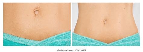 Female Abdomen Before After Treatment Stretch Stock Photo