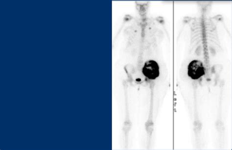 The Radiology Assistant Sclerotic Tumors