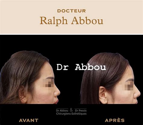 Rhinoplastie ethnique à Paris Dr Ralph ABBOU