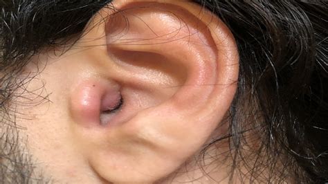 Learn How To Get Rid Of A Boil In Your Ear At Home Youtube