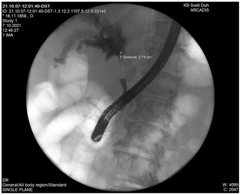 Diagnostics Free Full Text Klatskin Mimicking Lesions