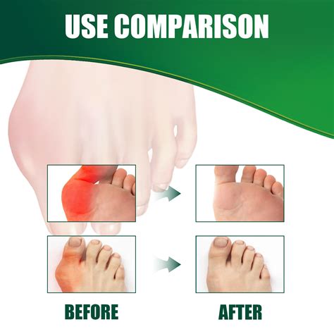 EELHOE Bunion Treatment Patch Thumb Corrector Reduce Uric Acid Relieve
