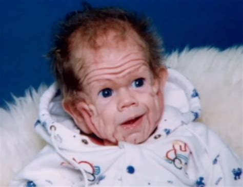 The Baby Who Stunned Doctors With His Rare Disorder What Does The
