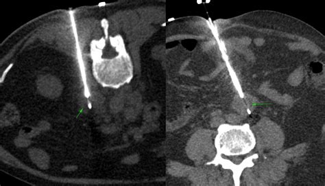 Case 43 Retroperitoneal Node Biopsy First Prone Then Supine